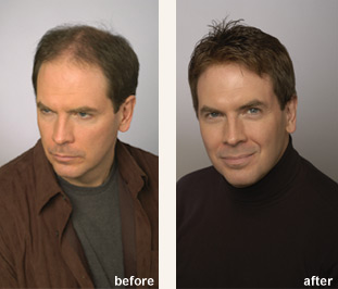 Bellevue Hair Loss Treatment